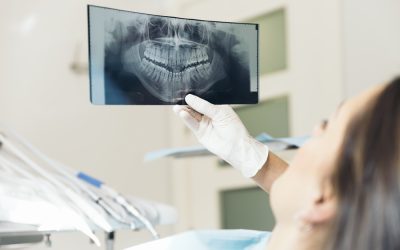 7 Commonly Asked Questions About Dental Crowns