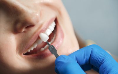 6 Important Things That You Need to Know about Dental Implants