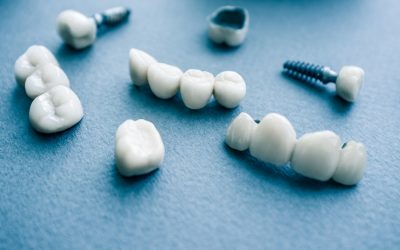 Top 6 Tips for Faster Dental Implant Recovery
