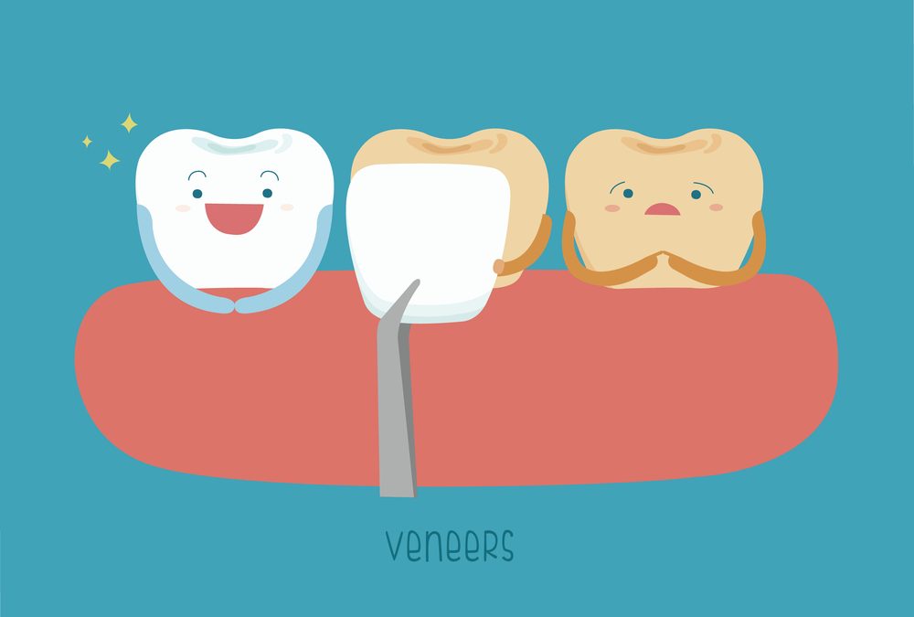 Tips to keep your dental veneers clean
