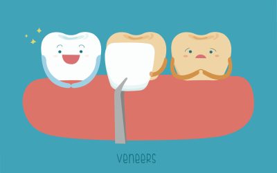 8 Tips for Properly Caring For Your Dental Veneers